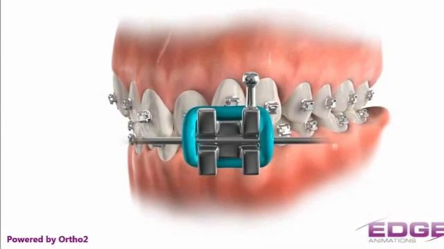 ORTODONCIA AUTOLIGADO DAMON Q - CLINICA DIANA DUSSAN смотреть онлайн