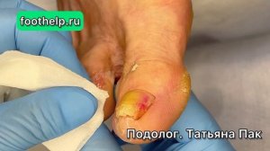 Сухая мозоль между пальцев