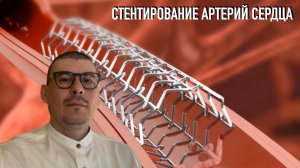 Как спасти сердце. Часть 2. Стентирование артерий сердца