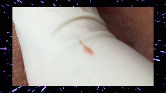 Косметолог очищает лицо от прыщей