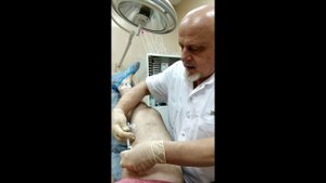 Процедура пенной склеротерапии 1