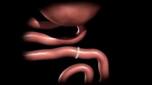 Шунтирование желудка