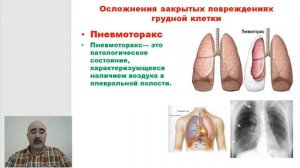Лекция 17 Закрытые повреждения грудной клетки часть 01