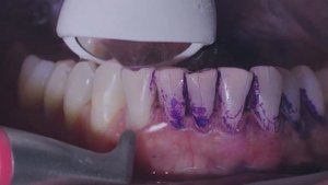 Профессиональная чистка полости рта Air-Flow