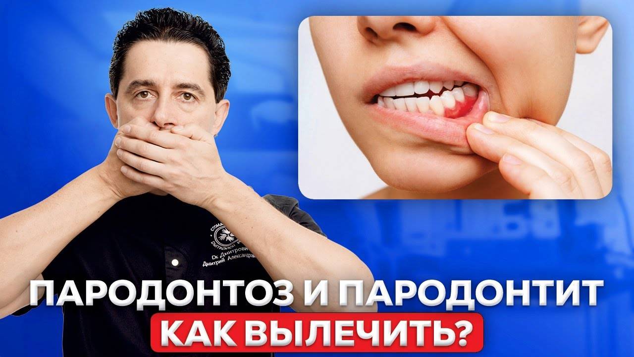Парадонтит или Парадонтоз?
