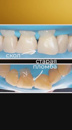 Спасаем улыбку от СКОЛА на зубе