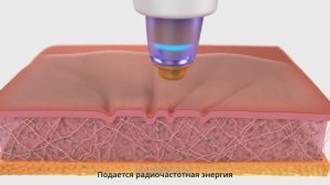 TempSure Envi для уменьшения морщин и подтяжки кожи