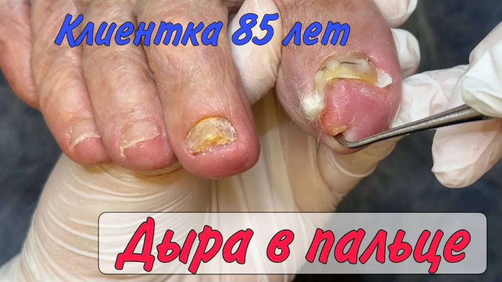 Дыра в пальце _ Вросший ноготь _ Старческие ногти