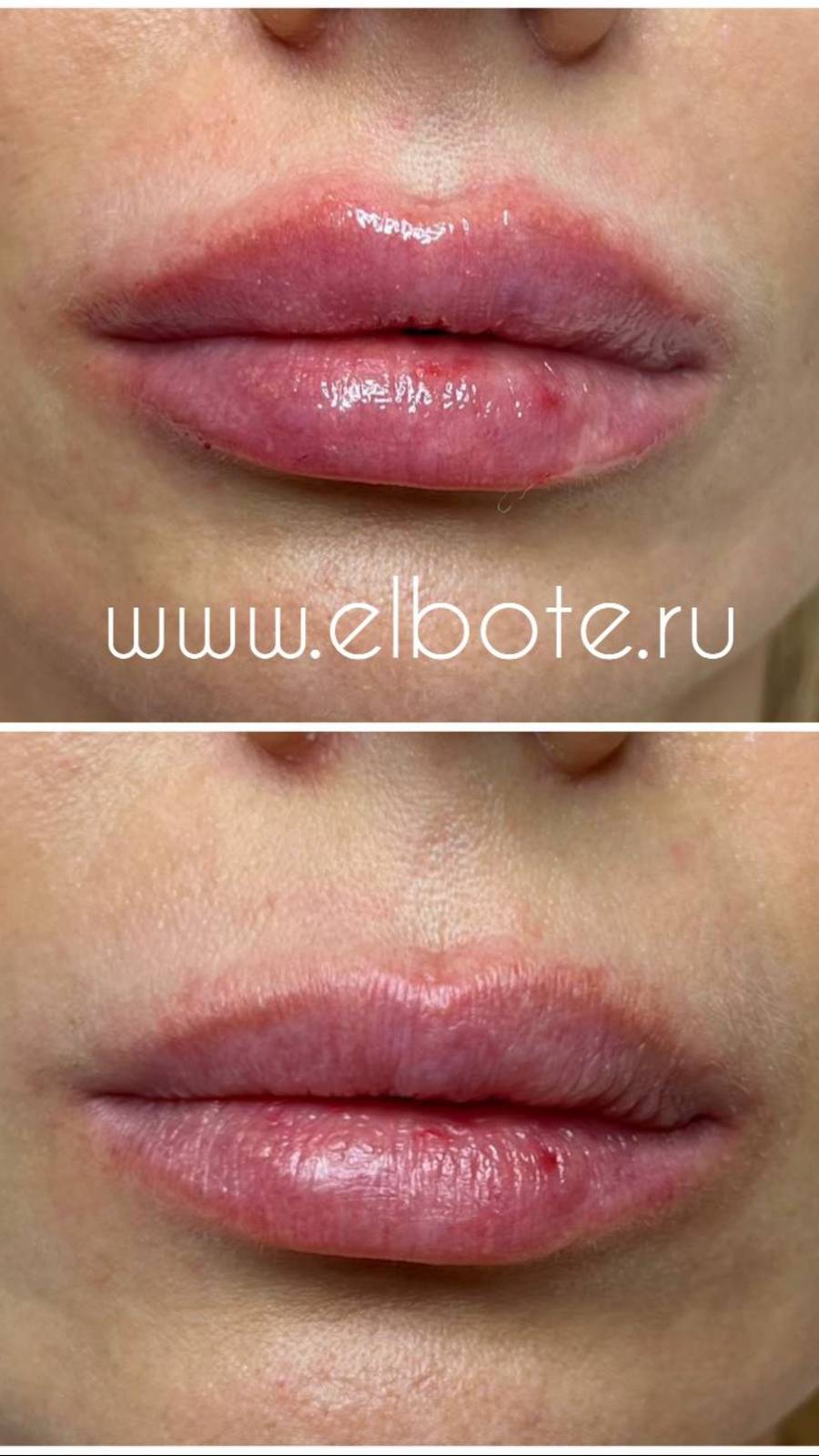 Увеличение губ смотреть онлайн