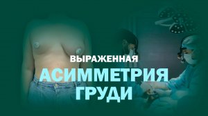 Исправить асимметрию груди: двухэтапная маммопластика шаг за шагом