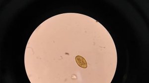 Paragonimus sp egg in sputum patient.