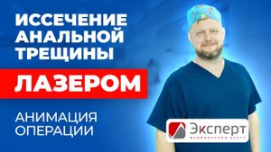 Иссечение анальной трещины лазером