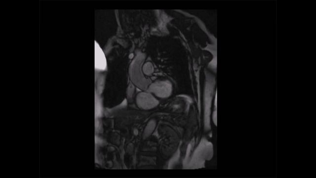 How to assess aortic stenosis using CMR смотреть онлайн