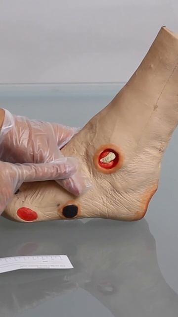 Measuring Wounds #woundcareadvantage #woundcare смотреть онлайн