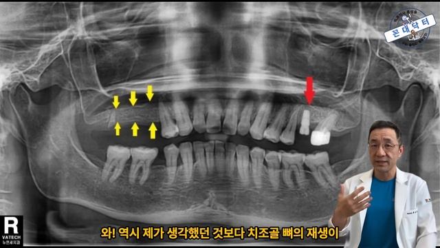 치아 발치 원인이 충치인 부위는 임플란트 강추, 발치 원인이 치주질환인 부위의 임플란트는 신중히 생각해야