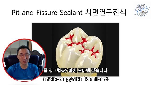 영구치 충치예방효과 탁월한 치아홈메우기 불소코팅, 어린이들뿐 아니라 어른들도 꼭 해야! Pit and fissure sealant to prevent dental caries