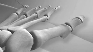 Hallux Valgus Repair with Arthrex® Mini TightRope®