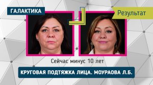 Круговая подтяжка лица результат | Моураова Лариса Батразовна