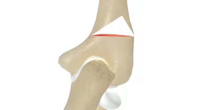 Unlock Elbow Movement With Valgus Triangular Osteotomy! смотреть онлайн