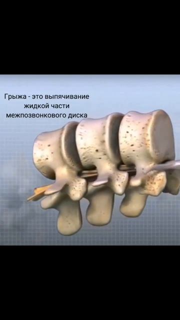 как избежать появления грыжи? #грыжадиска #грыжапозвоночника #поясница смотреть онлайн