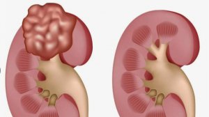 ЛЕЧЕНИЕ воспаления  ПОЧЕК _  целительство от А.Дуйко
