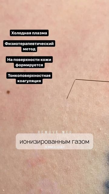 Холодная плазма и плазмолифтинг