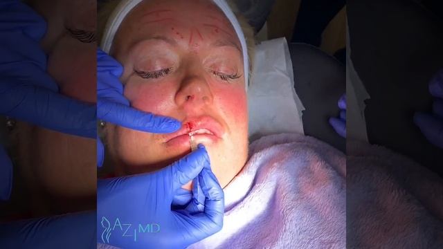 Non-surgical LipLift using dissolvable threads смотреть онлайн