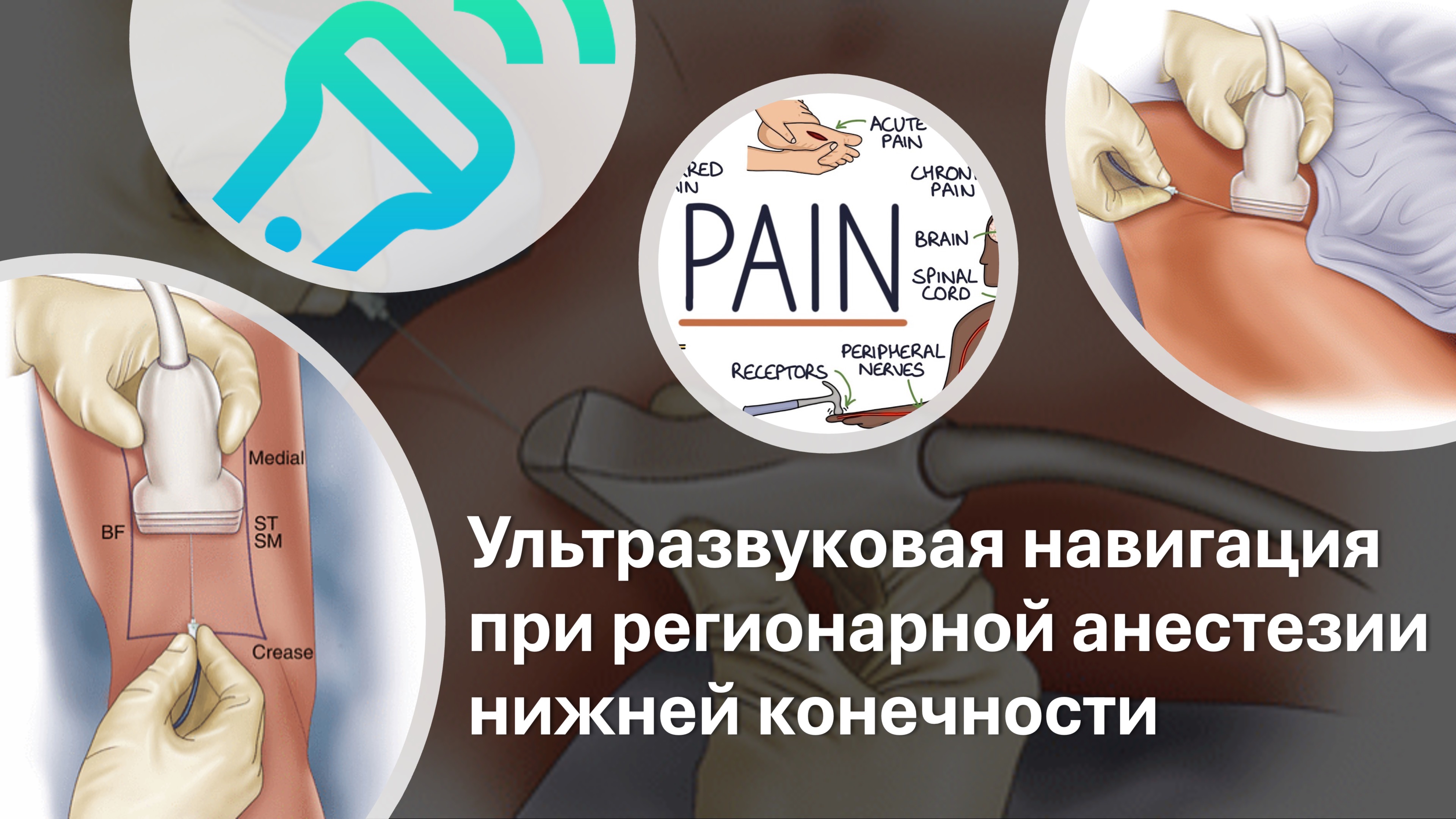 РЕГИОНАРНАЯ АНЕСТЕЗИЯ НИЖНЕЙ КОНЕЧНОСТИ ПОД КОНТРОЛЕМ УЛЬТРАЗВУКА #узи #анестезия #узинавигация
