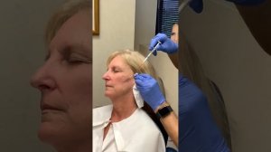 Skin tightening & rejuvenation with Radiesse