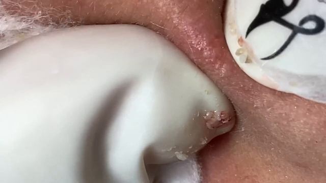 Acne Treatment Huong Da Nang# Membership 020 | Happy Start Of The Week
