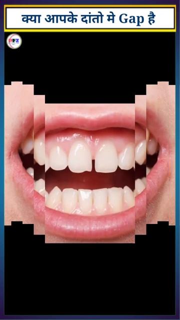क्या आपके दांतो मे Gap है? | Diastema | Diastema Closure #shorts смотреть онлайн
