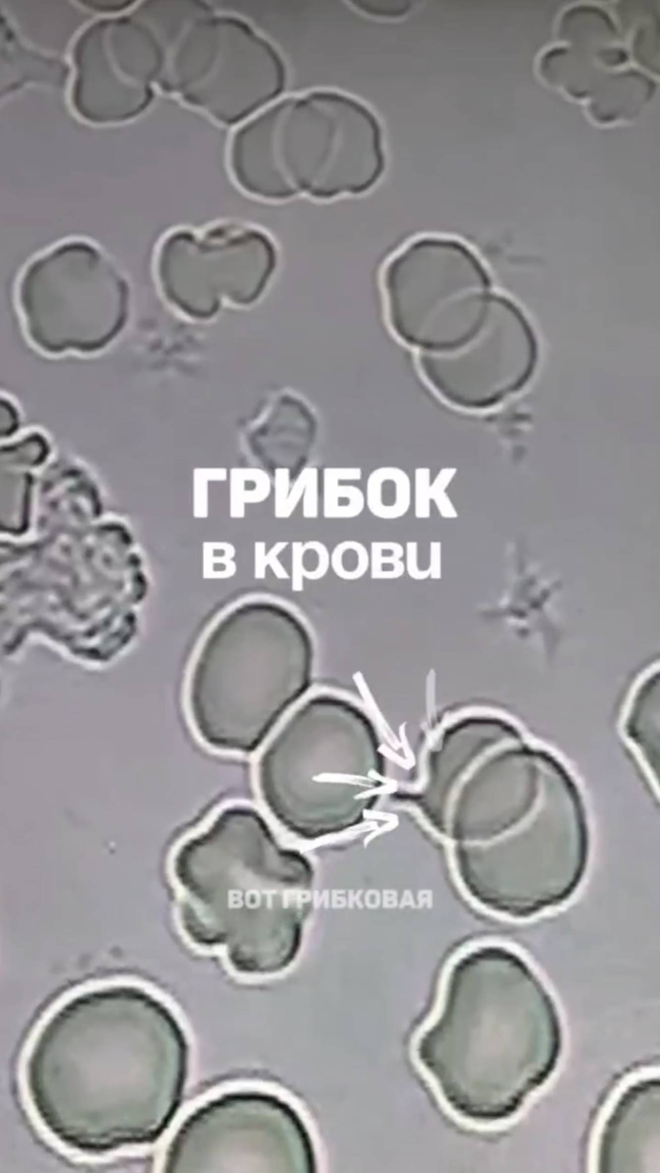 Грибок в крови. Кандида, грибковая инфекция в крови. Съёмка под микроскопом