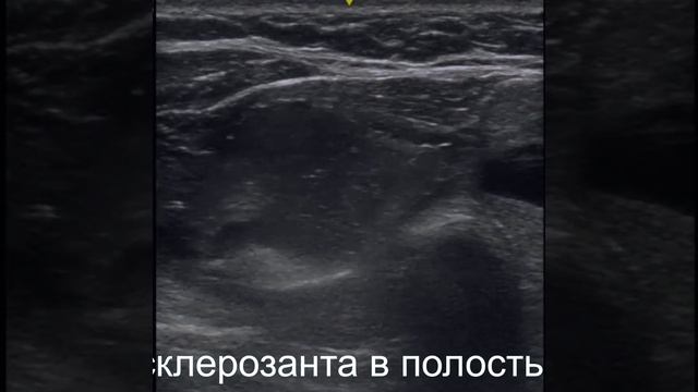 Склерозирование кисты правой доли щитовидной железы смотреть онлайн
