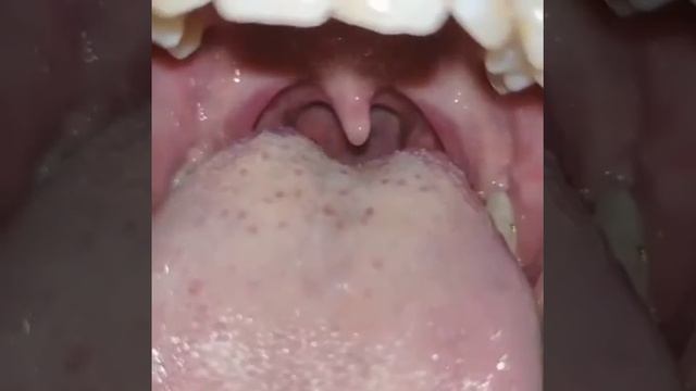 Vore