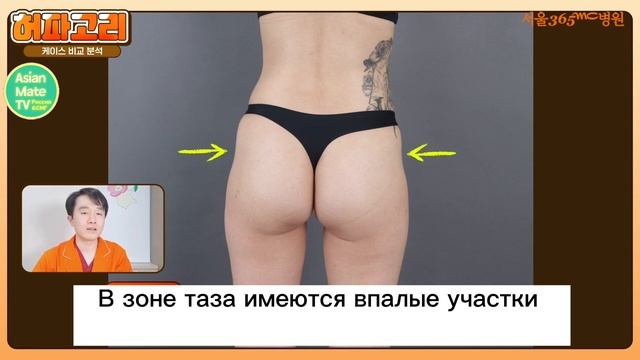 Липосакция / красивая фигура/ до и после/ результаты пациентов