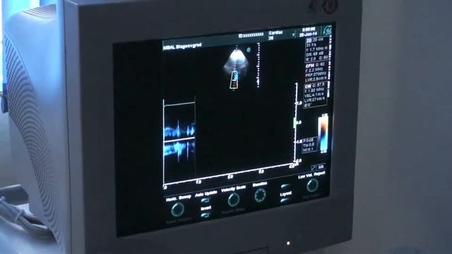 Ехокардиография смотреть онлайн