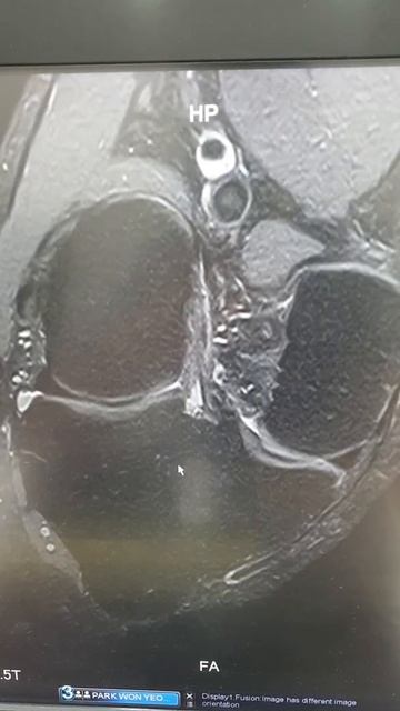 knee mri ACL image