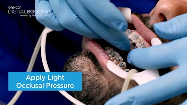 Achieve customized bracket positioning смотреть онлайн