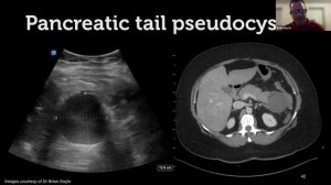 How to: Ultrasound the Pancreas  - Zedu POCUS Coaching Corner - 1 July 2021