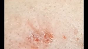 Pimple Popping Milia Removal (Greatest Satisfying Video!)