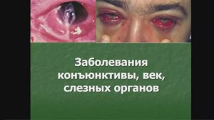 9_50 лекция №3 Заболевания конъюнктивы, век, слезных органов КФУ Медицинская академия Иванова Н В