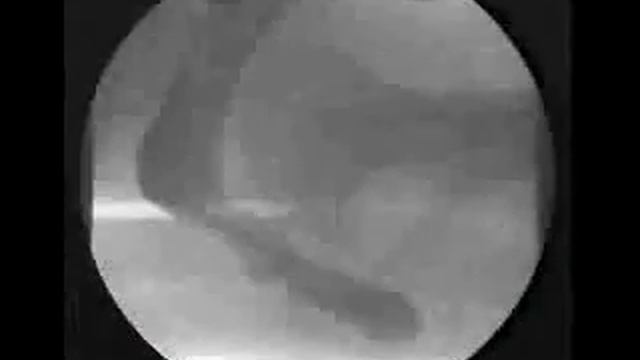 Medical Video : Defecography showing Rectocele смотреть онлайн