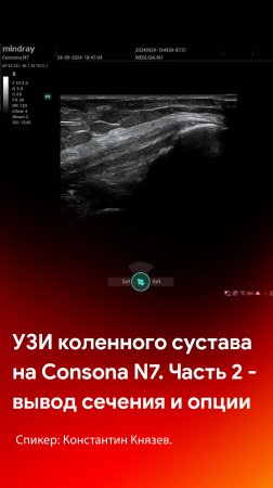 УЗИ коленного сустава на Mindray Consona N7. Часть 2 - вывод сечения и опции