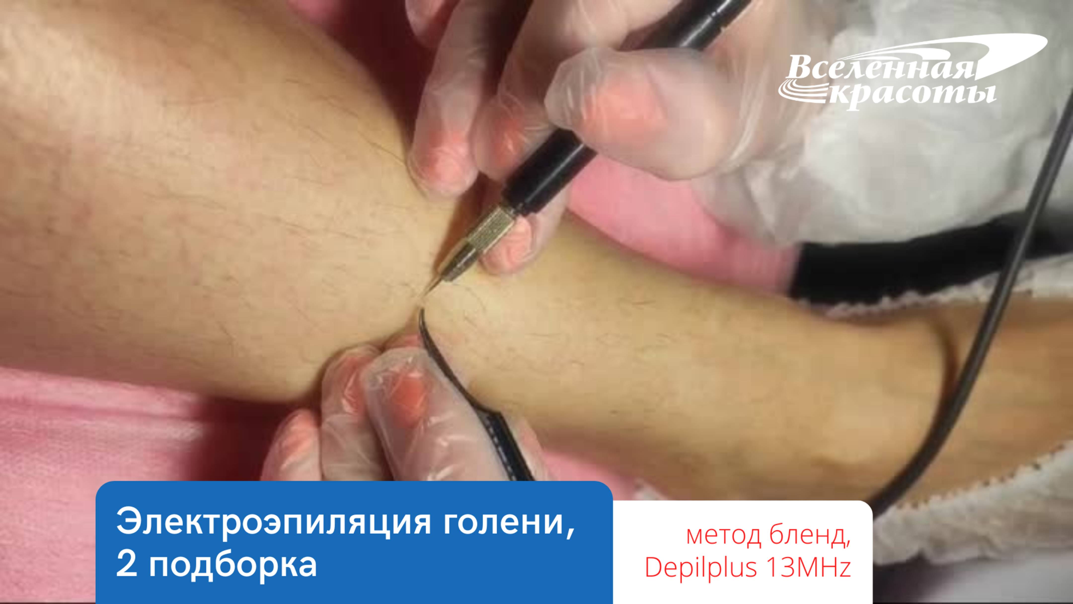 Электроэпиляция голени, 2 подборка