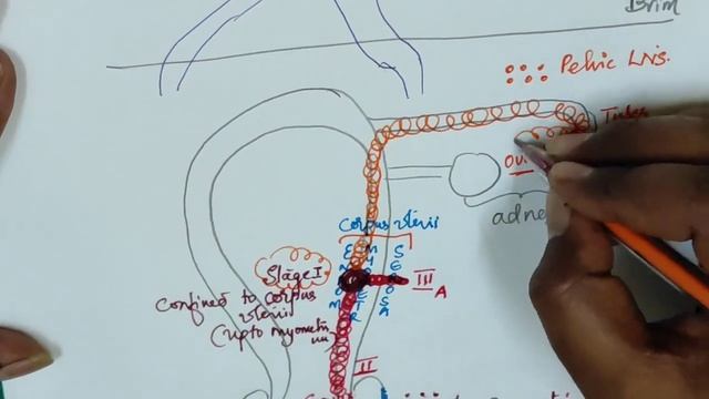 FIGO STAGING OF CARCINOMA ENDOMETRIUM | BY Dr.ANIL THIMMANAYAKA смотреть онлайн