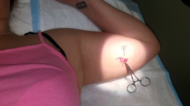 A simplified method for removal of nexplanon implants, Dr. AL-HENDY, Feb, 2017 смотреть онлайн