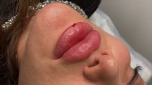 Увеличение губ / увеличить губы