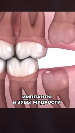 Перед имплантацией мы обязательно проверяем, нет ли непрорезавшихся 8-рок.