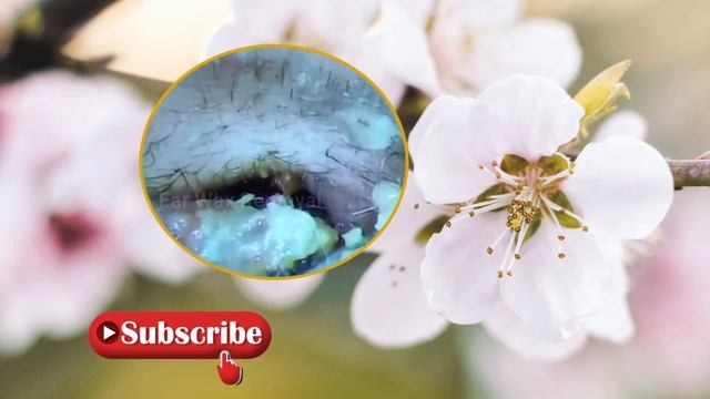 Ear Wax Removal - dead skin peel & ear wax removal ; 耳垢の除去-死んだ皮膚の皮と耳垢の除去＃13 смотреть онлайн