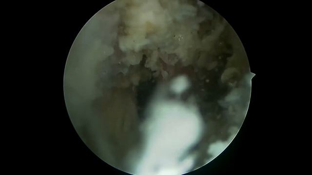 IKEDA Shoulder Surgery with HD Endoscope Camera смотреть онлайн